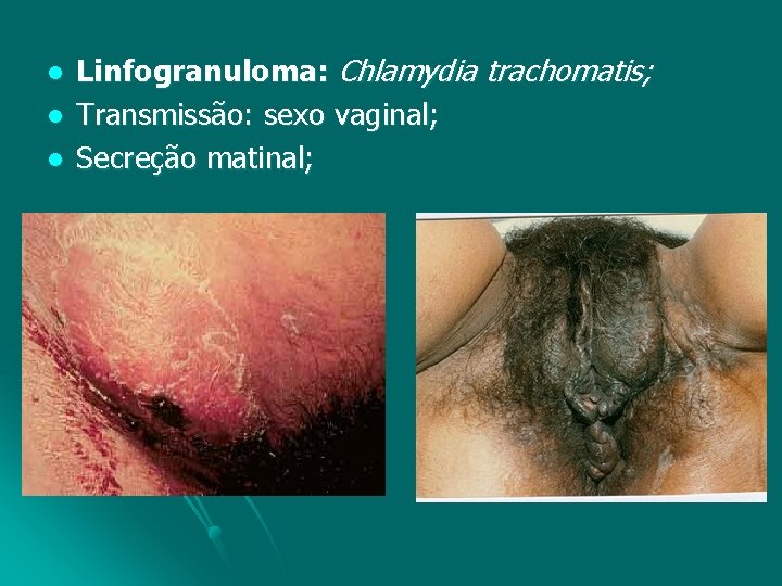 l l l Linfogranuloma: Chlamydia trachomatis; Transmissão: sexo vaginal; Secreção matinal; 