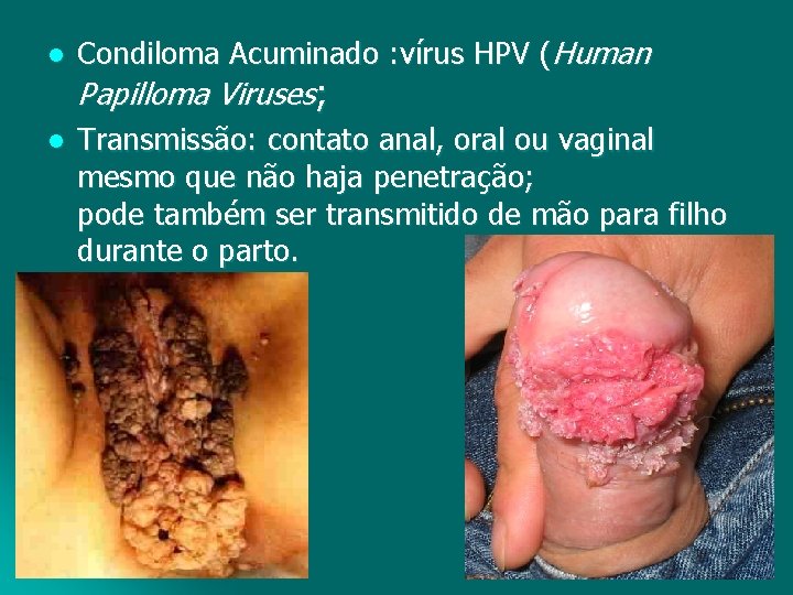 l Condiloma Acuminado : vírus HPV (Human Papilloma Viruses; l Transmissão: contato anal, oral