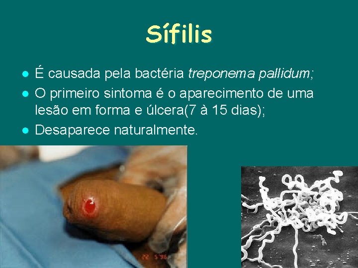 Sífilis l l l É causada pela bactéria treponema pallidum; O primeiro sintoma é