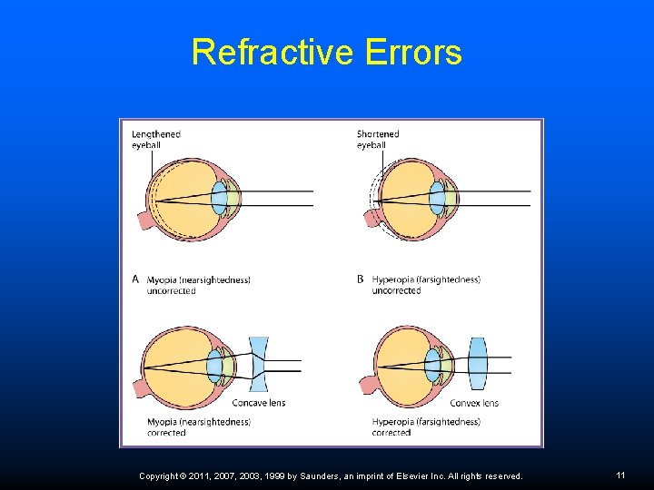 Refractive Errors Copyright © 2011, 2007, 2003, 1999 by Saunders, an imprint of Elsevier