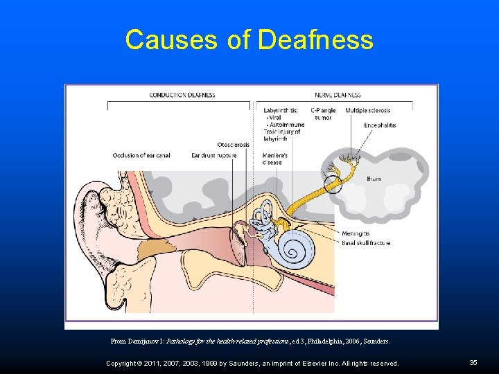 Causes of Deafness From Damijanov I: Pathology for the health-related professions, ed 3, Philadelphia,