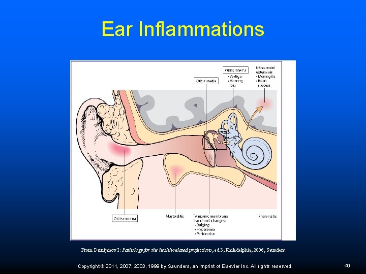 Ear Inflammations From Damijanov I: Pathology for the health-related professions, ed 3, Philadelphia, 2006,