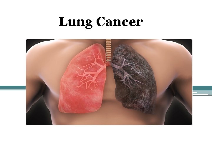 Lung Cancer 