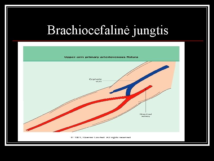 Brachiocefalinė jungtis 