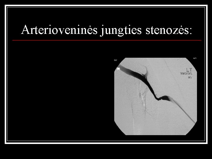 Arterioveninės jungties stenozės: 