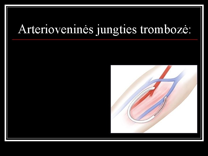 Arterioveninės jungties trombozė: 