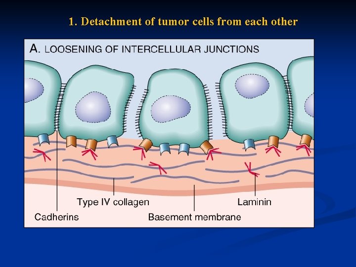 1. Detachment of tumor cells from each other 