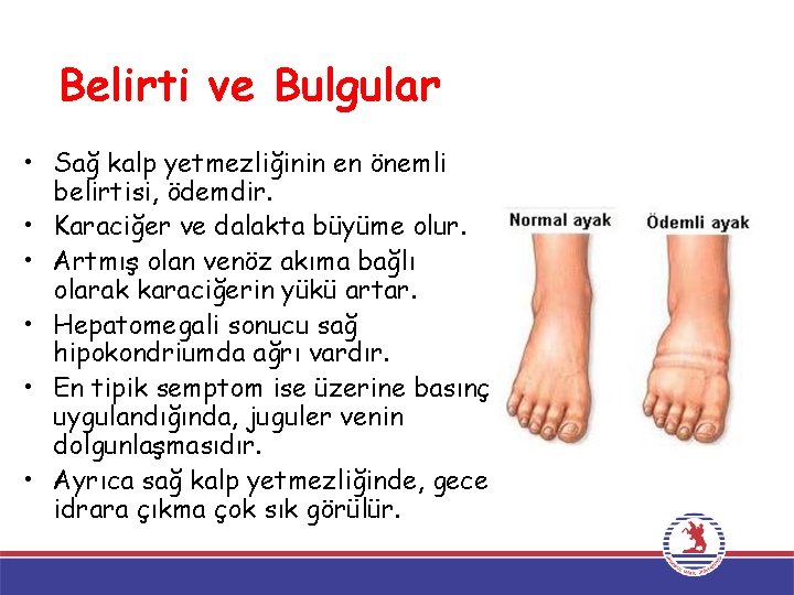 Belirti ve Bulgular • Sağ kalp yetmezliğinin en önemli belirtisi, ödemdir. • Karaciğer ve