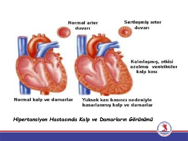 Hipertansiyon Hastasında Kalp ve Damarların Görünümü 