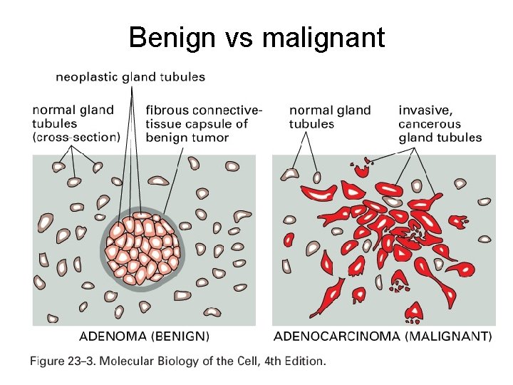 Benign vs malignant 