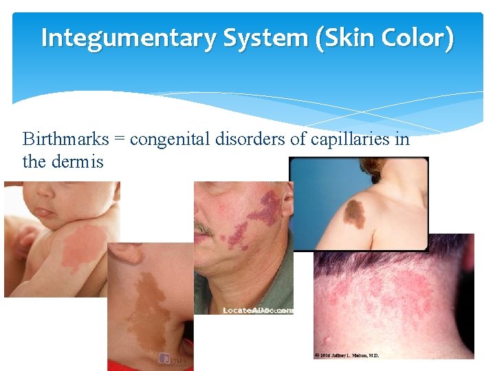 Integumentary System (Skin Color) Birthmarks = congenital disorders of capillaries in the dermis 