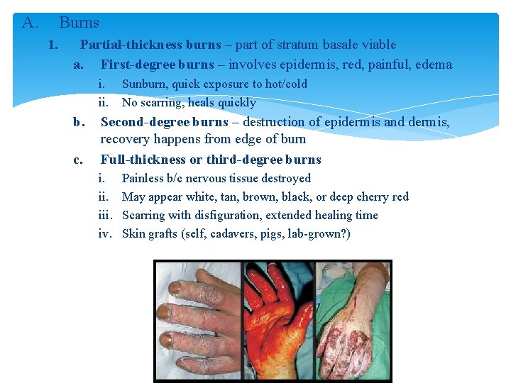 A. Burns 1. Partial-thickness burns – part of stratum basale viable a. First-degree burns