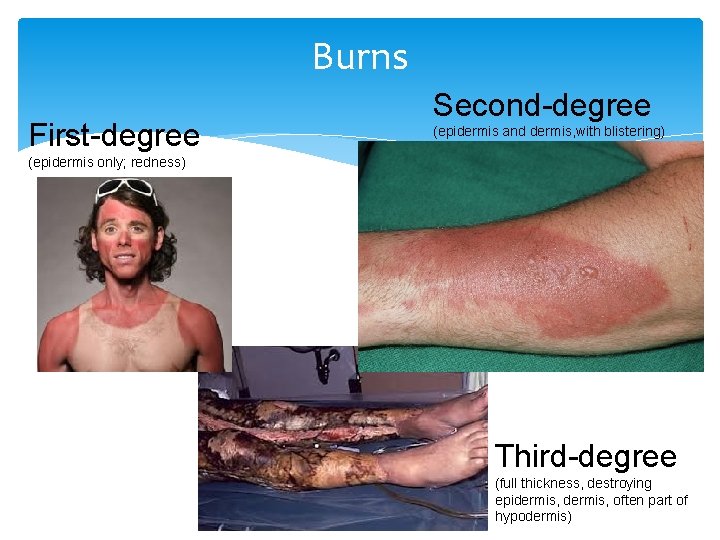 Burns First-degree Second-degree (epidermis and dermis, with blistering) (epidermis only; redness) Third-degree (full thickness,