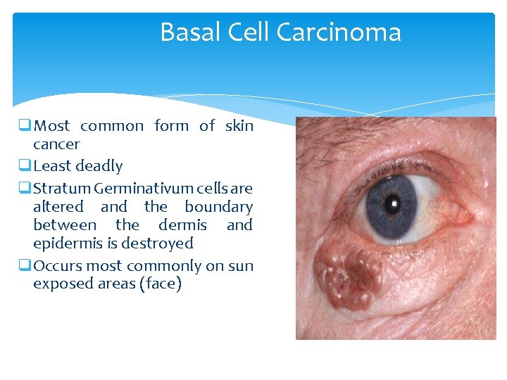 Basal Cell Carcinoma q. Most common form of skin cancer q. Least deadly q.