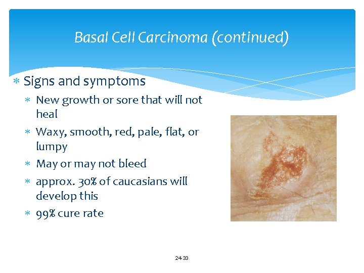 Basal Cell Carcinoma (continued) Signs and symptoms New growth or sore that will not