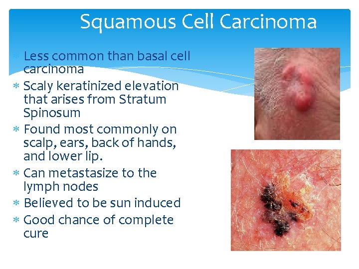 Squamous Cell Carcinoma Less common than basal cell carcinoma Scaly keratinized elevation that arises