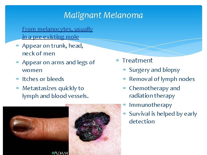 Malignant Melanoma From melanocytes, usually in a pre-existing mole Appear on trunk, head, neck