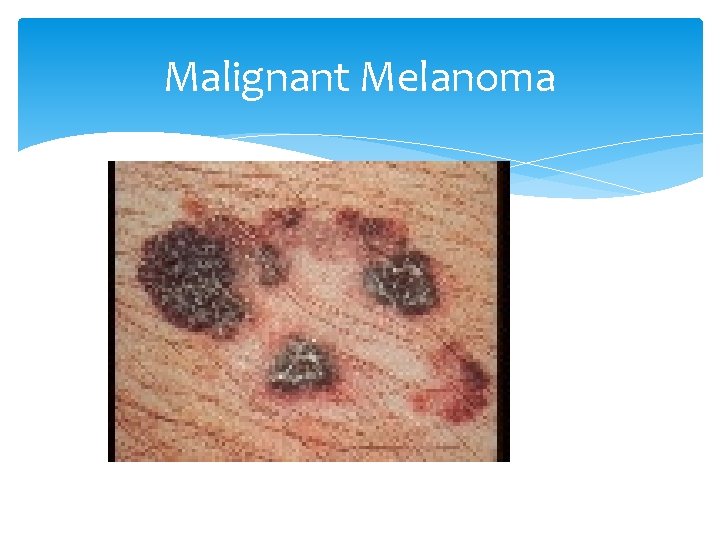 Malignant Melanoma 