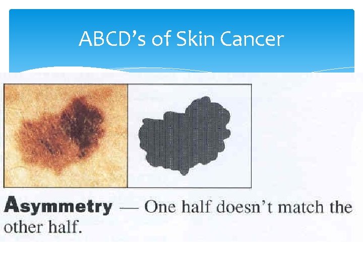 ABCD’s of Skin Cancer 