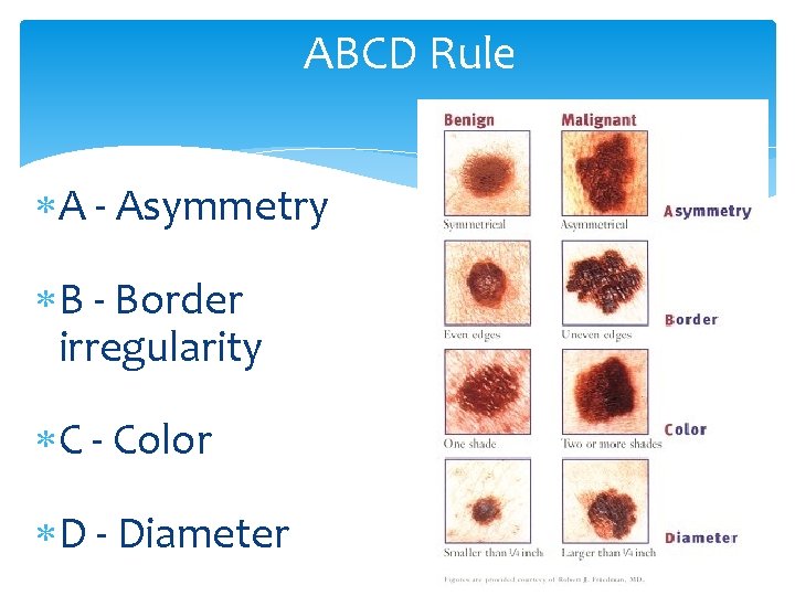 ABCD Rule A - Asymmetry B - Border irregularity C - Color D -