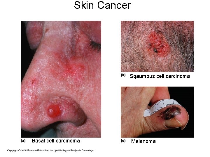 Skin Cancer Sqaumous cell carcinoma Basal cell carcinoma Melanoma 