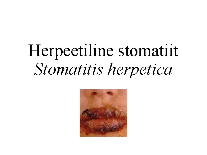 Herpeetiline stomatiit Stomatitis herpetica 