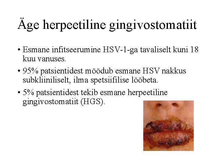 Äge herpeetiline gingivostomatiit • Esmane infitseerumine HSV-1 -ga tavaliselt kuni 18 kuu vanuses. •