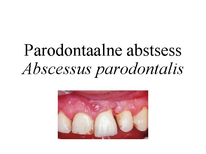 Parodontaalne abstsess Abscessus parodontalis 