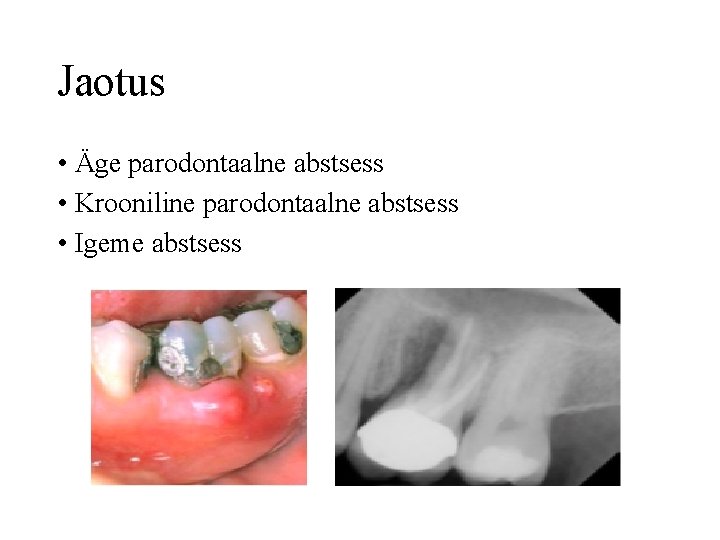 Jaotus • Äge parodontaalne abstsess • Krooniline parodontaalne abstsess • Igeme abstsess 