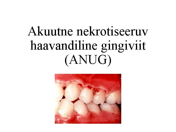 Akuutne nekrotiseeruv haavandiline gingiviit (ANUG) 