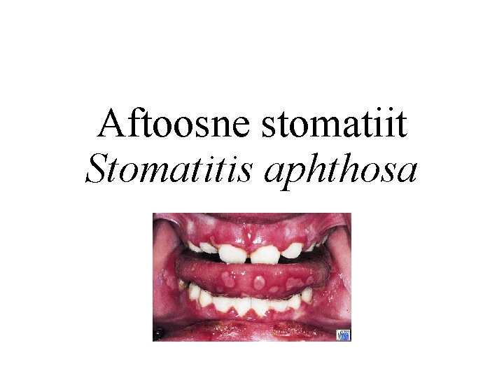 Aftoosne stomatiit Stomatitis aphthosa 