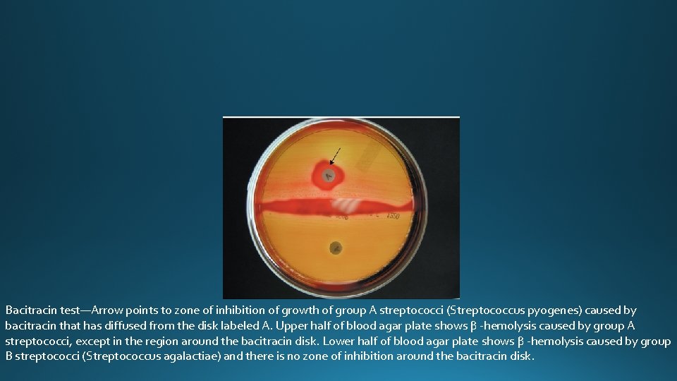Bacitracin test—Arrow points to zone of inhibition of growth of group A streptococci (Streptococcus