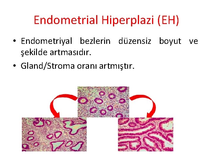 Endometrial Hiperplazi (EH) • Endometriyal bezlerin düzensiz boyut ve şekilde artmasıdır. • Gland/Stroma oranı