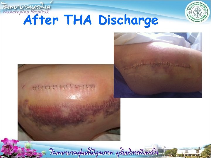 After THA Discharge 