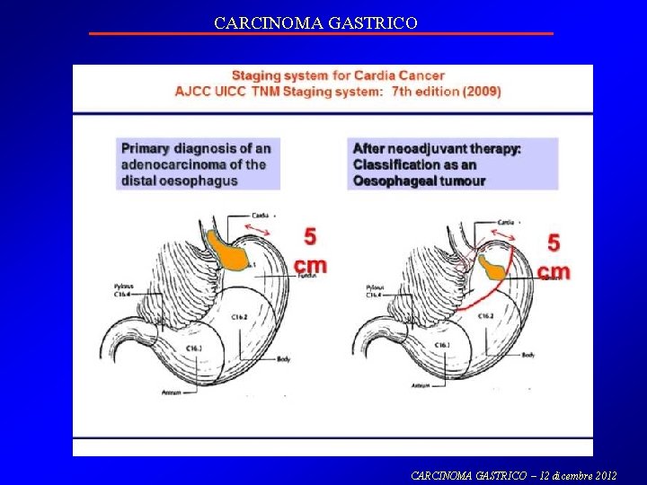 CARCINOMA GASTRICO – 12 dicembre 2012 