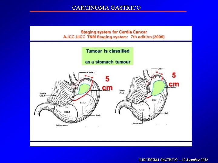 CARCINOMA GASTRICO – 12 dicembre 2012 