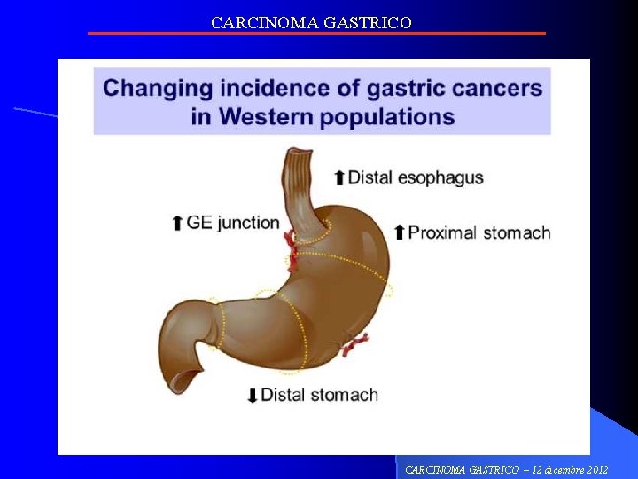 CARCINOMA GASTRICO – 12 dicembre 2012 