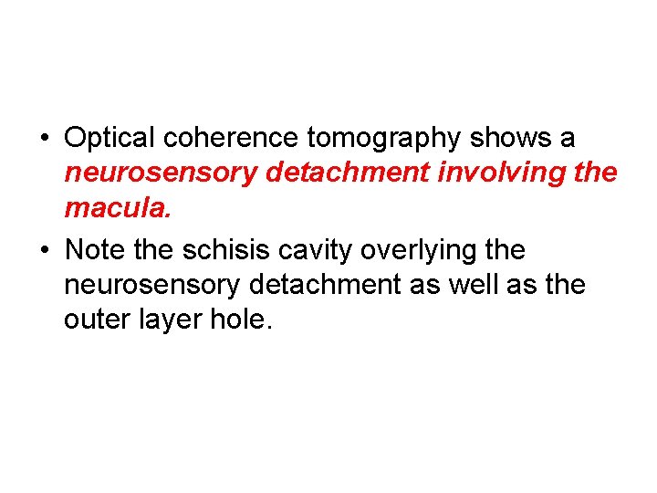  • Optical coherence tomography shows a neurosensory detachment involving the macula. • Note