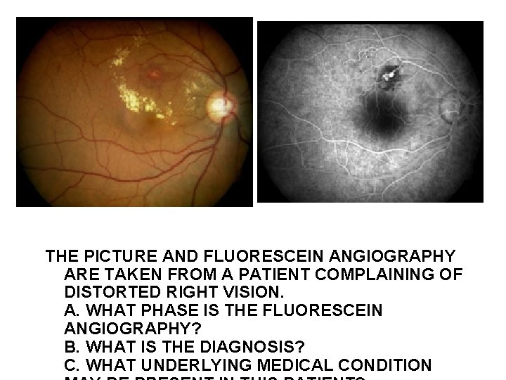 THE PICTURE AND FLUORESCEIN ANGIOGRAPHY ARE TAKEN FROM A PATIENT COMPLAINING OF DISTORTED RIGHT