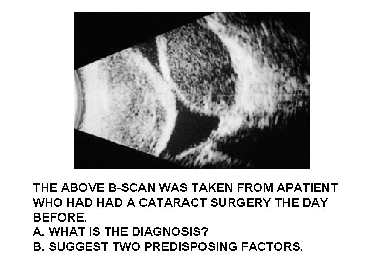 THE ABOVE B-SCAN WAS TAKEN FROM APATIENT WHO HAD A CATARACT SURGERY THE DAY