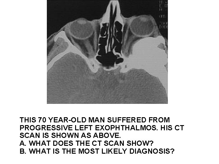 THIS 70 YEAR-OLD MAN SUFFERED FROM PROGRESSIVE LEFT EXOPHTHALMOS. HIS CT SCAN IS SHOWN