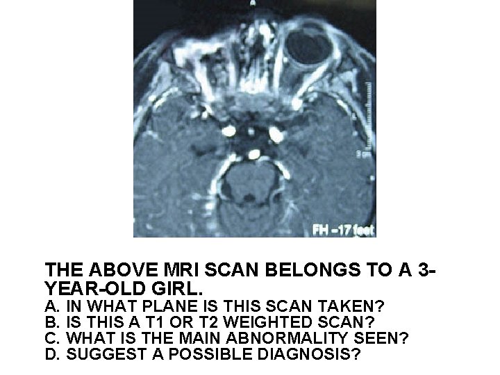 THE ABOVE MRI SCAN BELONGS TO A 3 YEAR-OLD GIRL. A. IN WHAT PLANE