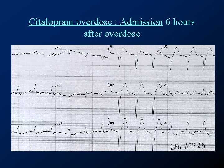 Citalopram overdose : Admission 6 hours after overdose 