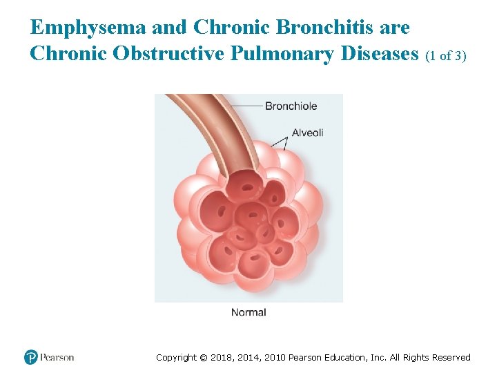 Emphysema and Chronic Bronchitis are Chronic Obstructive Pulmonary Diseases (1 of 3) Copyright ©