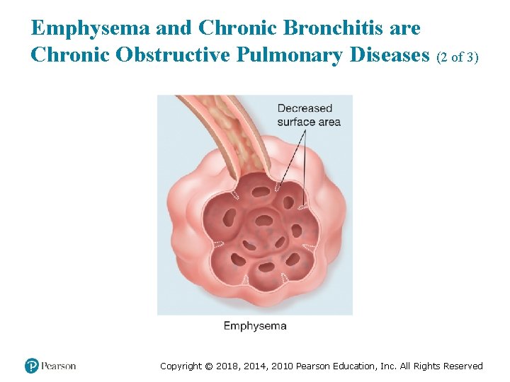 Emphysema and Chronic Bronchitis are Chronic Obstructive Pulmonary Diseases (2 of 3) Copyright ©