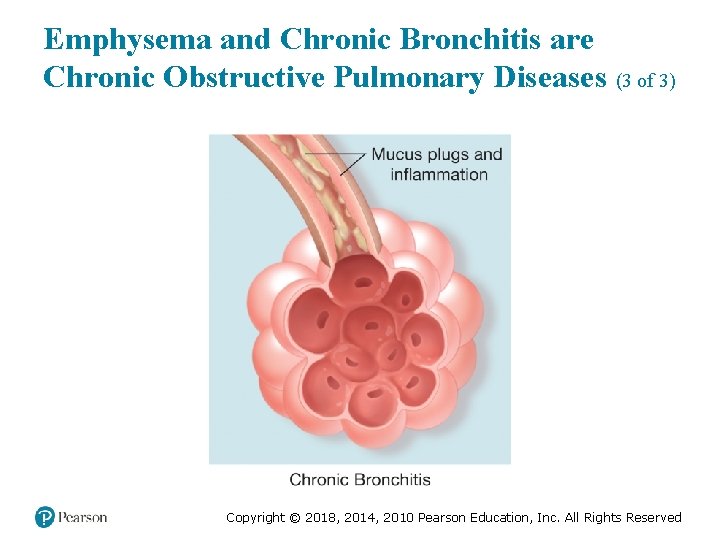 Emphysema and Chronic Bronchitis are Chronic Obstructive Pulmonary Diseases (3 of 3) Copyright ©