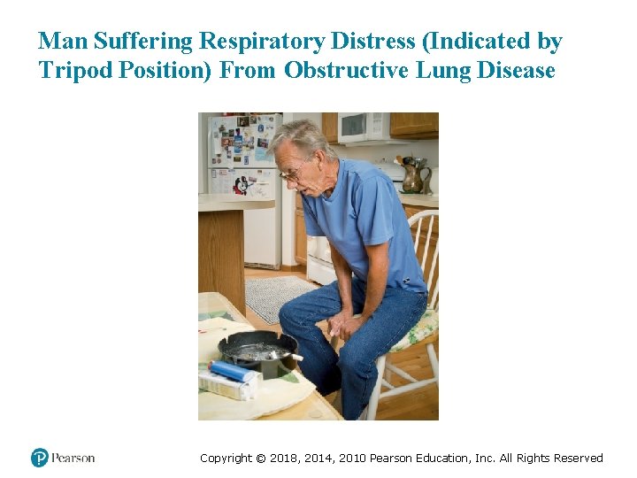 Man Suffering Respiratory Distress (Indicated by Tripod Position) From Obstructive Lung Disease Copyright ©