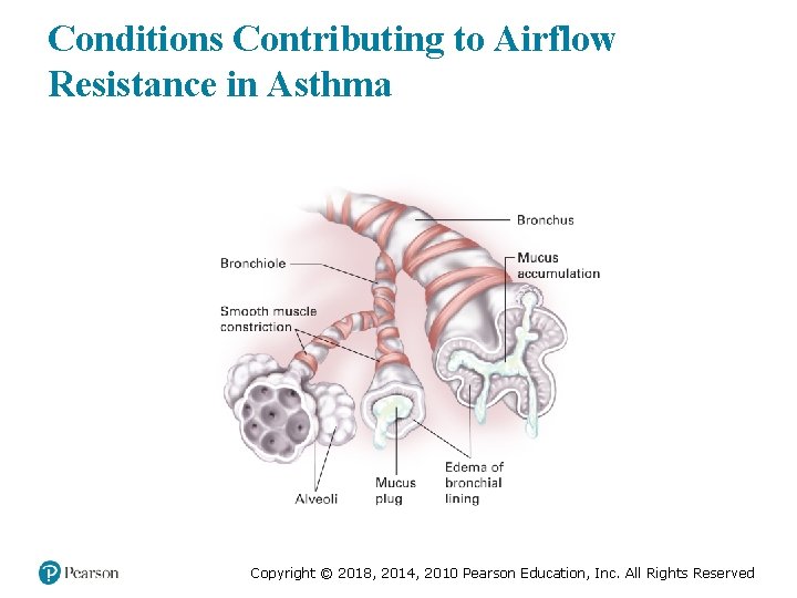 Conditions Contributing to Airflow Resistance in Asthma Copyright © 2018, 2014, 2010 Pearson Education,