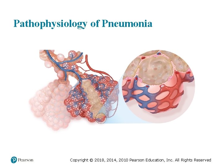 Pathophysiology of Pneumonia Copyright © 2018, 2014, 2010 Pearson Education, Inc. All Rights Reserved