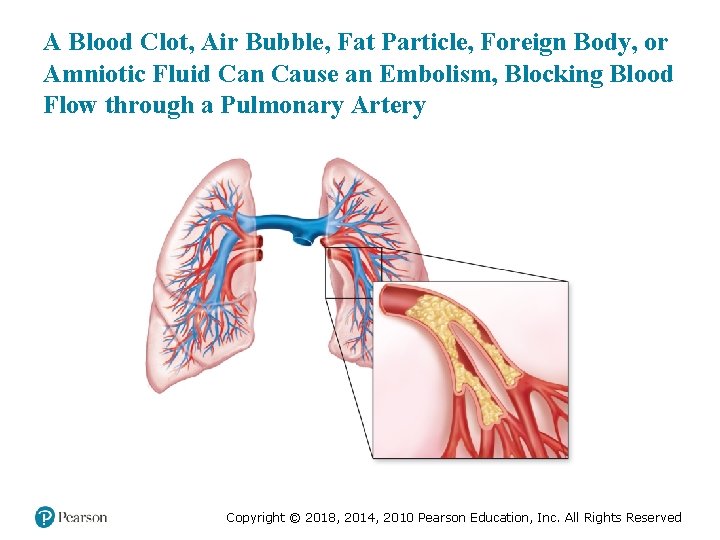 A Blood Clot, Air Bubble, Fat Particle, Foreign Body, or Amniotic Fluid Can Cause